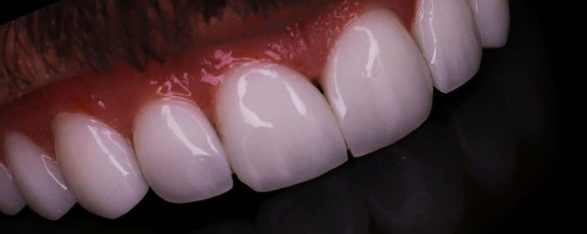 کامپوزیت نانو سرامیک برای مراجع دارای فاصله دندانی