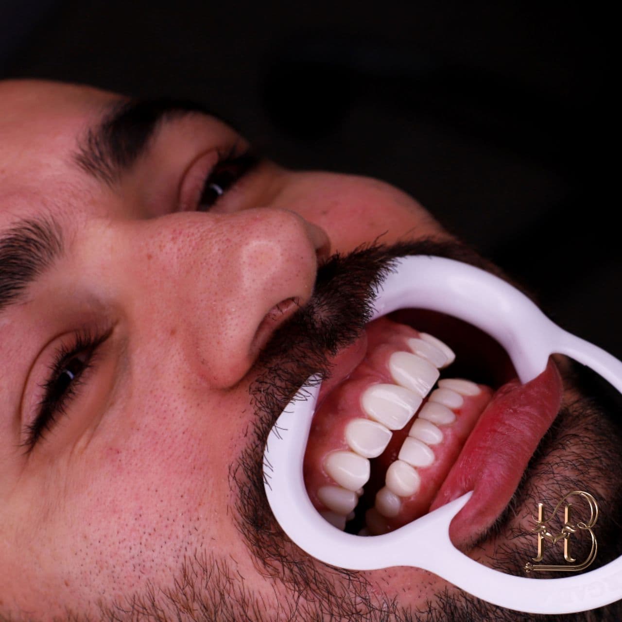 کامپوزیت نانو سرامیک برای مراجع دارای فاصله دندانی
