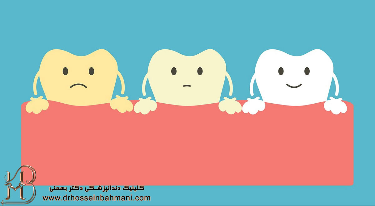 تصويری گرافيكی از تغيير رنگ دندان ها