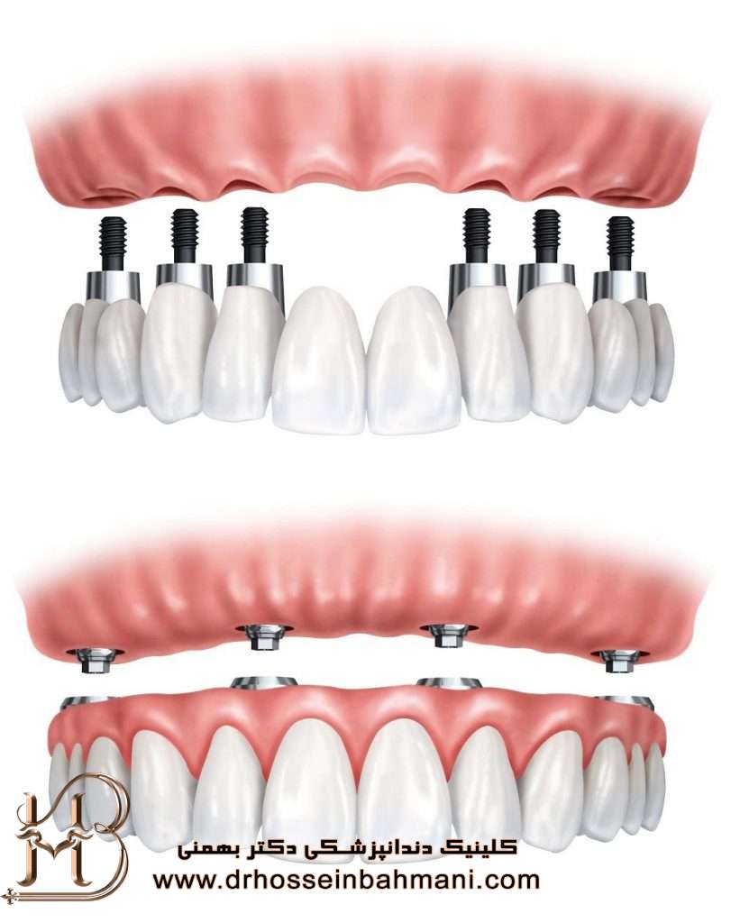 دندان مصنوعی ثابت بر پایه ایمپلنت