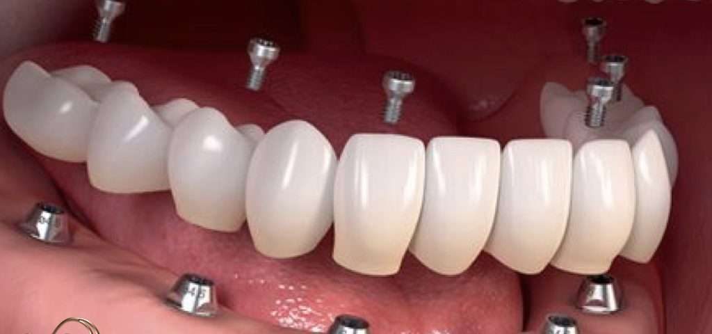 انواع تکنیک ایمپلنت دندان