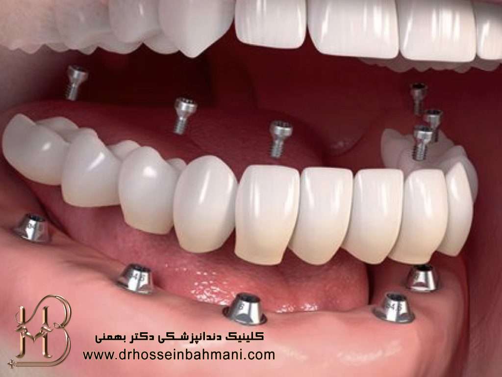 انواع تکنیک ایمپلنت دندان