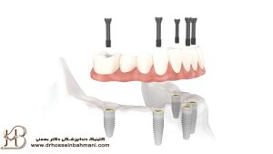 ایمپلنت دندان مصنوعی 