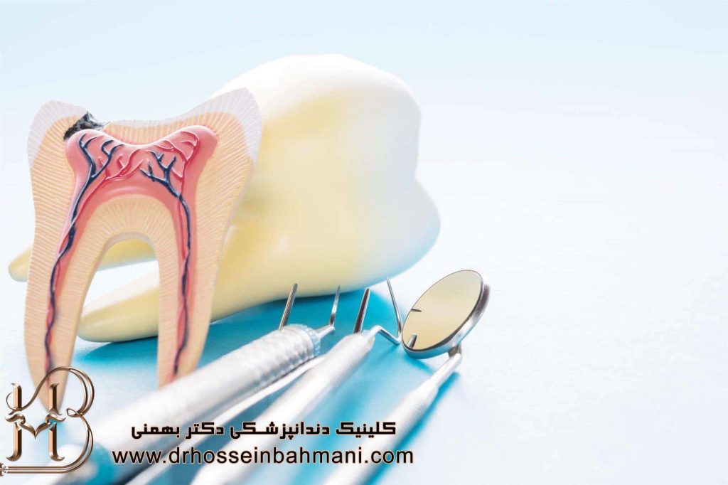 کانال ریشه دندان و پوسیدگی