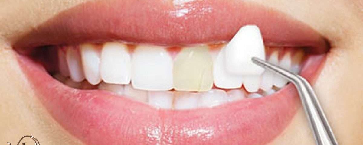 کامپوزیت دندان برند آلمانی