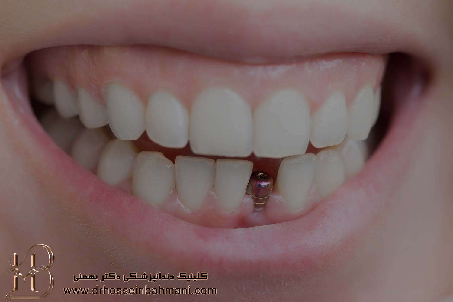 عمر ایمپلنت دندان