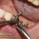تاریخچه ایمپلنت دندان