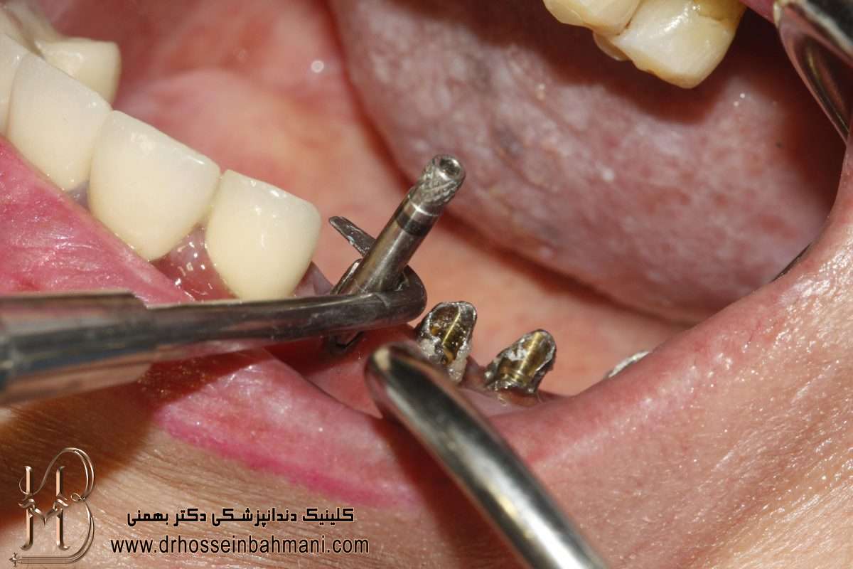 کاشت ایمپلنت دندان