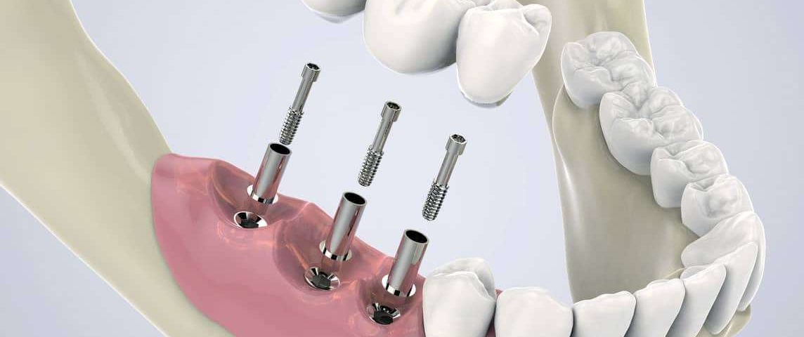 جلوگیری از شکست ایمپلنت دندان