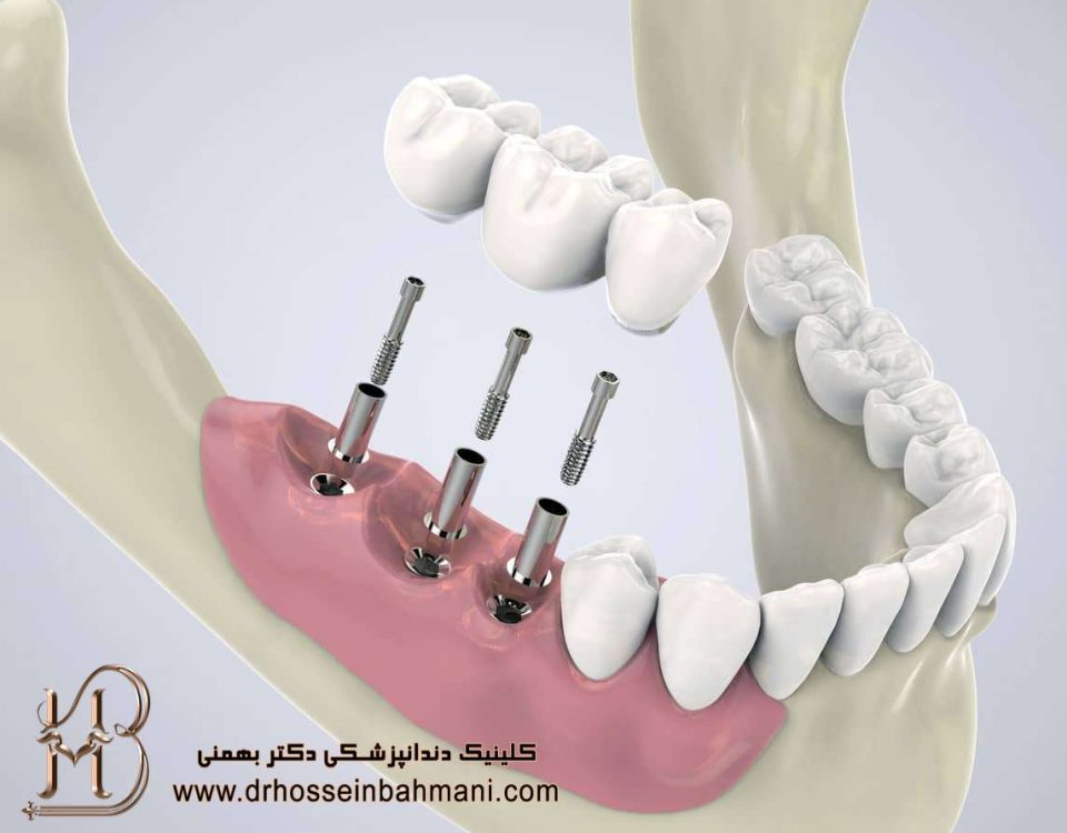 جلوگیری از شکست ایمپلنت دندان