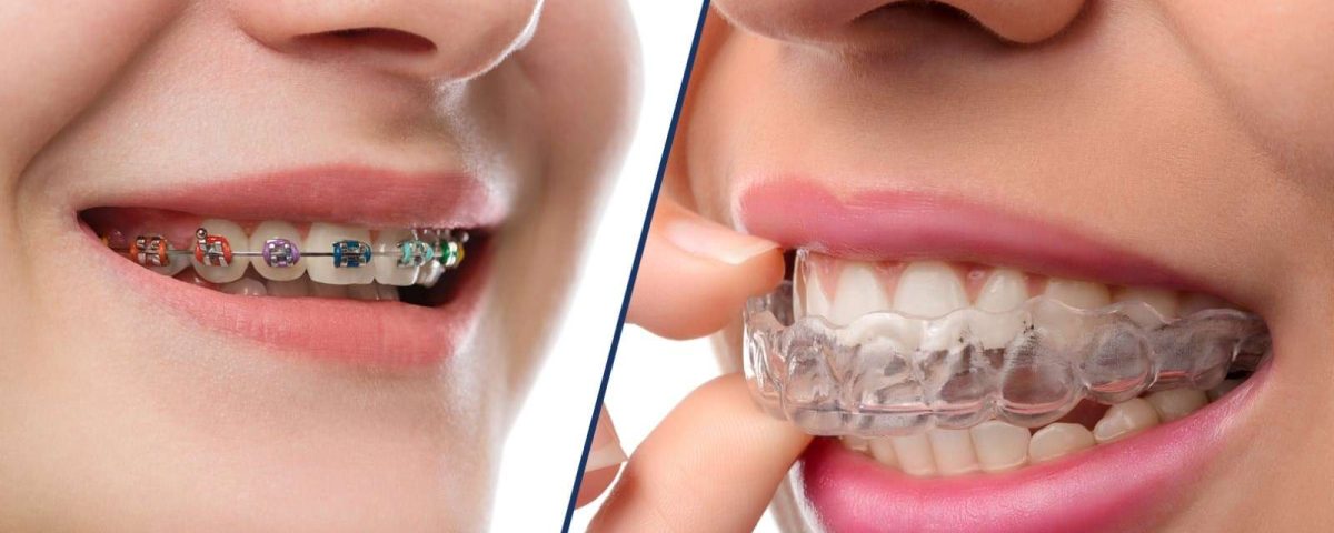 زیبایی دندان با ارتودنسی نامریی