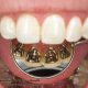 رفع نامرتبی دندان‌ها با ارتودنسی لینگوال