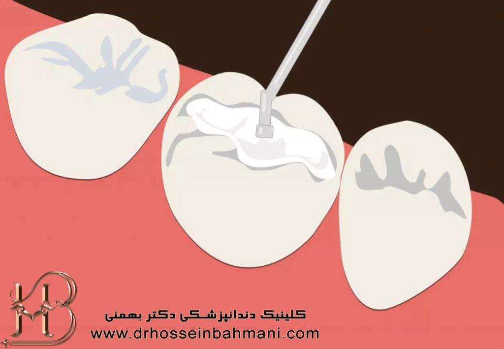 روش سیلانت دندان