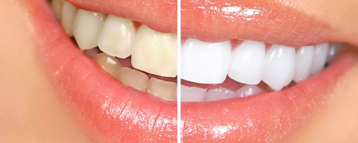 دندانی درخشان و سفید با بلیچینگ