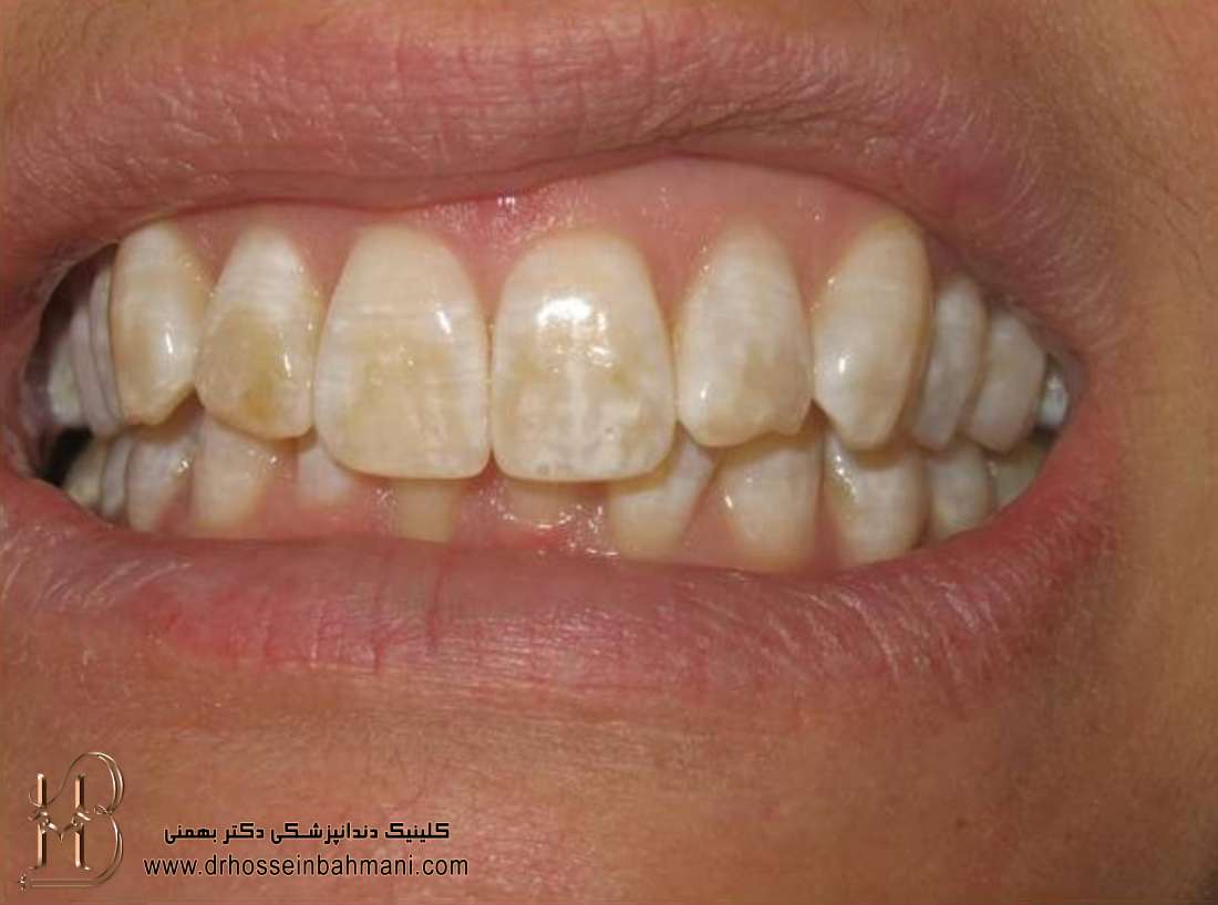 درمان لک روی دندان ها