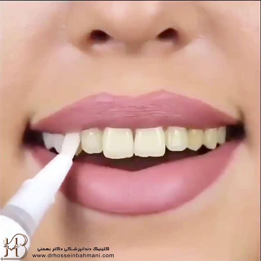 لاک سفید کننده دندان