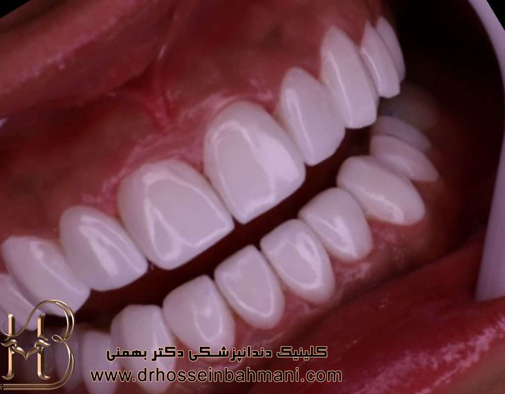 نمونه کار لمینت دندان دکتر بهمنی