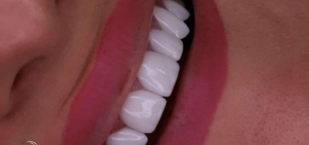 لمینت با رنگ طبیعی دندان