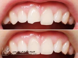 شکستن کامپوزیت دندان علت و درمان
