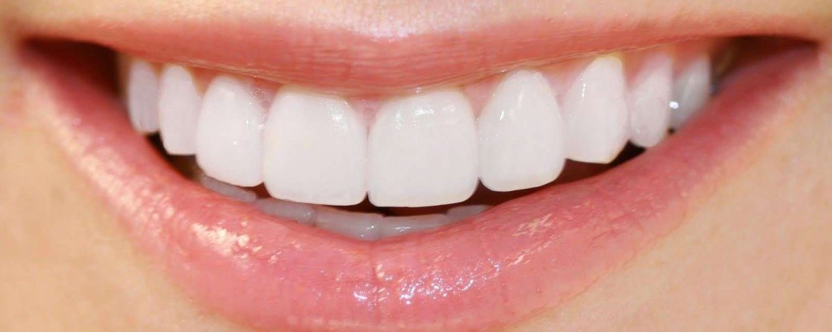 لمینت دندان با لبه شیشه ای