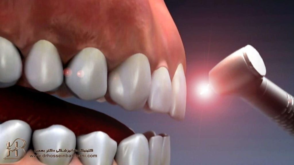 ایمپلنت دندان لیزری