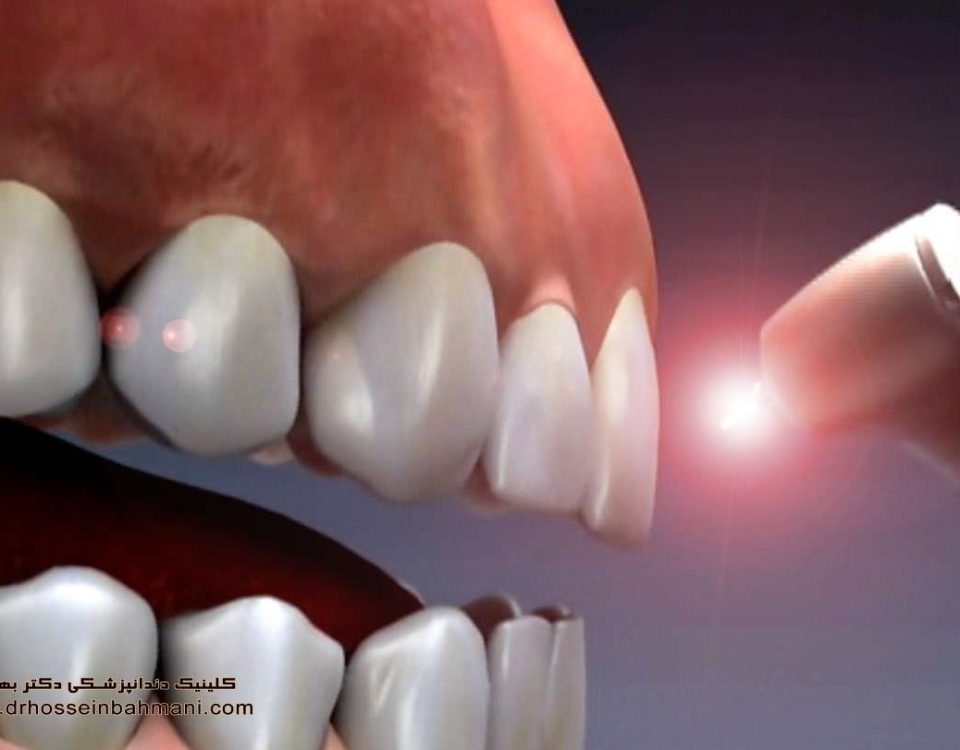 ایمپلنت دندان لیزری