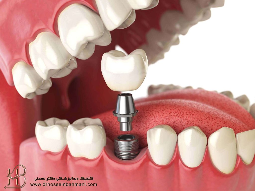 تصورات اشتباه ایمپلنت دندان