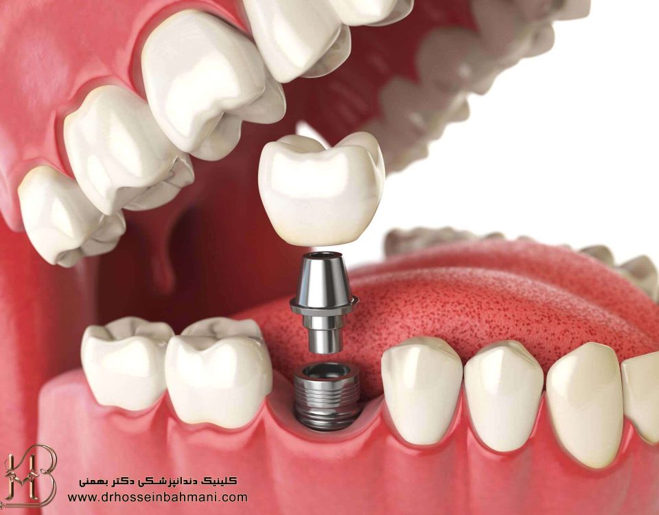 تصورات اشتباه ایمپلنت دندان