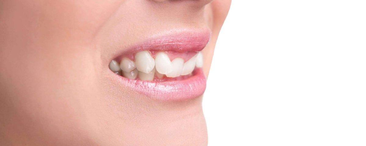 درمان بیرون زدگی دندان با کامپوزیت ونیر
