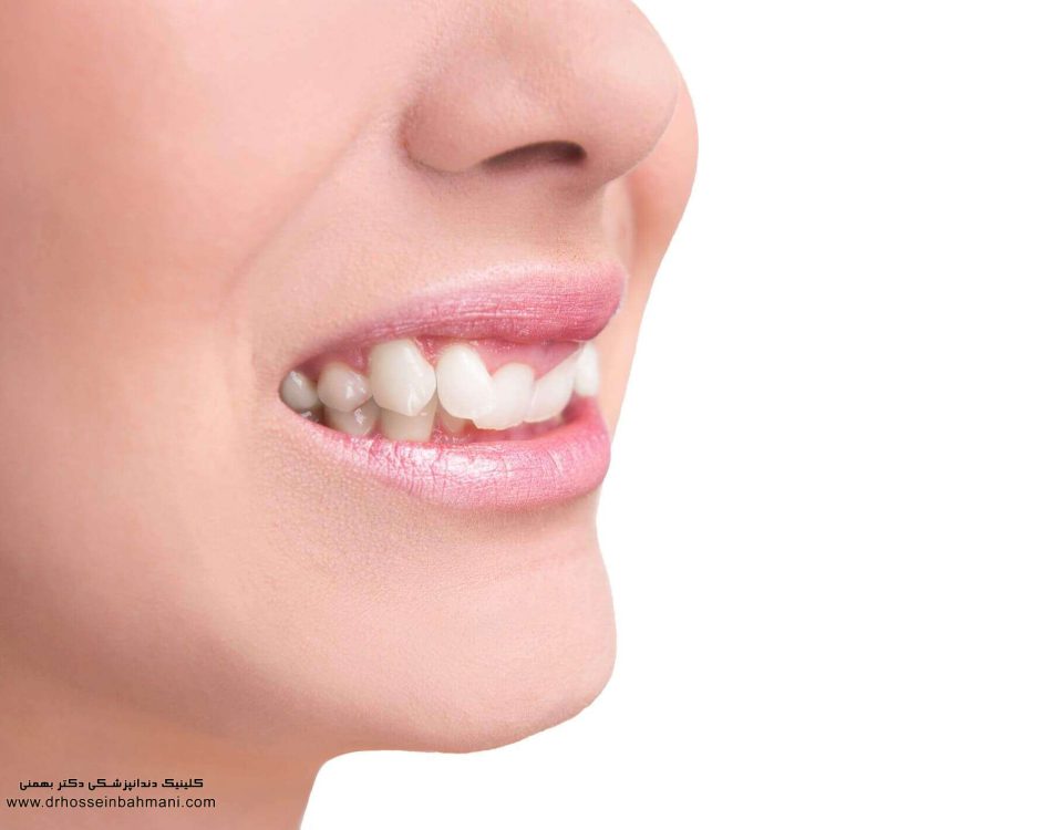 درمان بیرون زدگی دندان با کامپوزیت ونیر