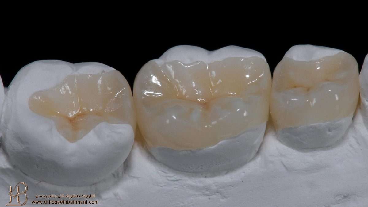 بازسازی تاج دندان چگونه انجام می‌شود