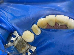 بازسازی تاج دندان