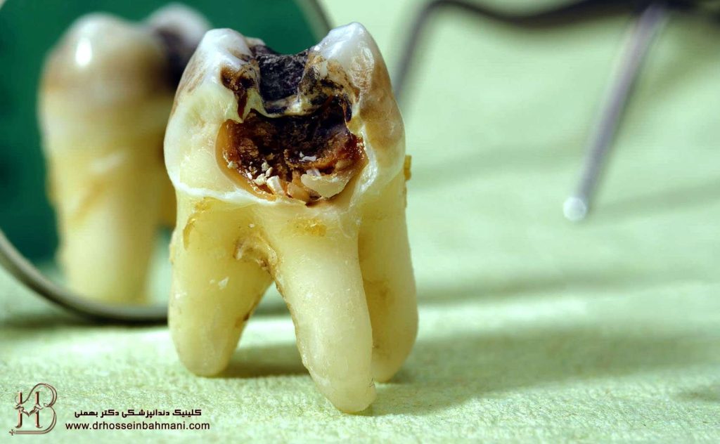 از بین رفتن دندان و علل