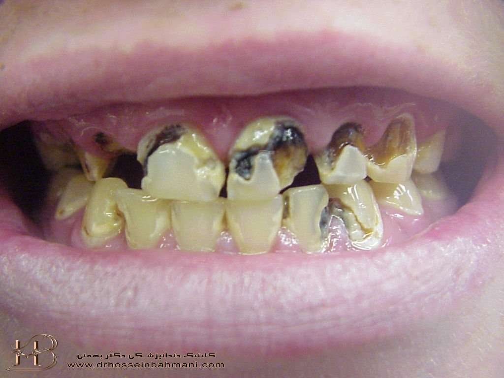 از بین رفتن دندان