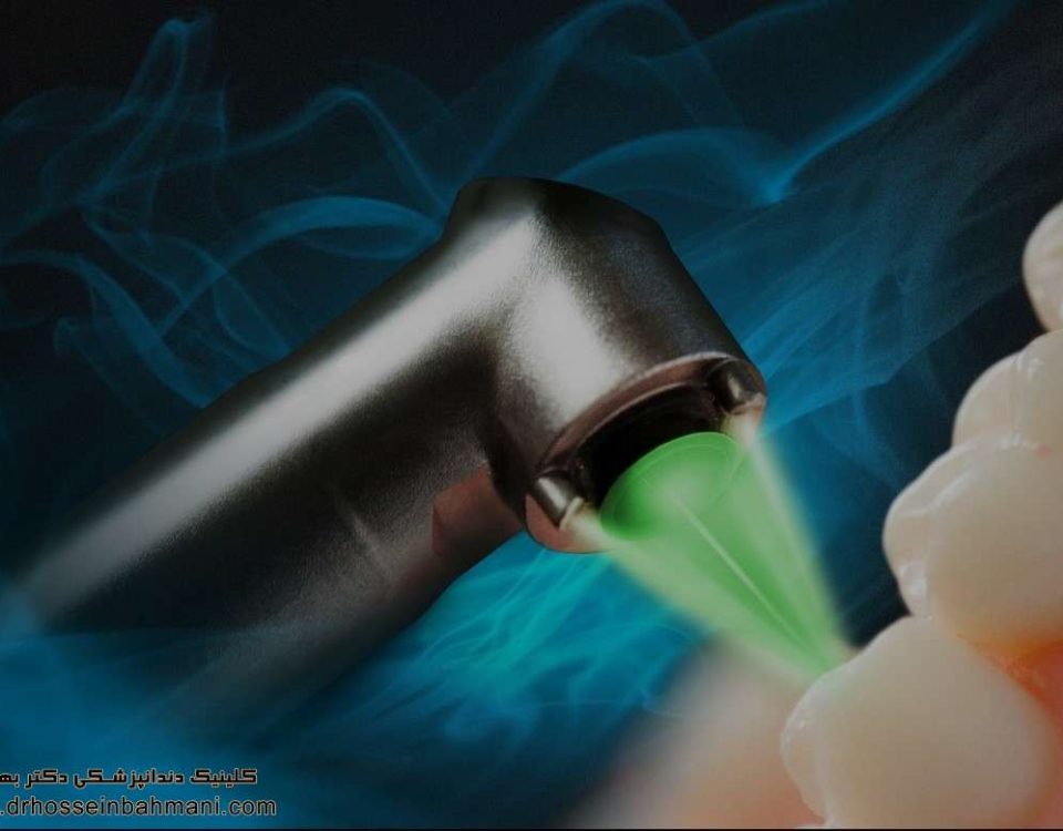کاربرد لیزر در دندانپزشکی زیبایی