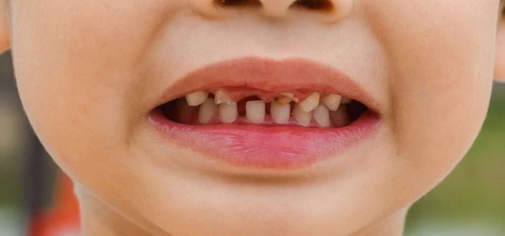 پوسیدگی دندان شیری و دندان‌های دائمی
