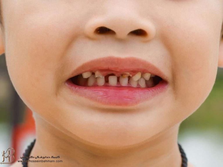 پوسیدگی دندان شیری و دندان‌های دائمی