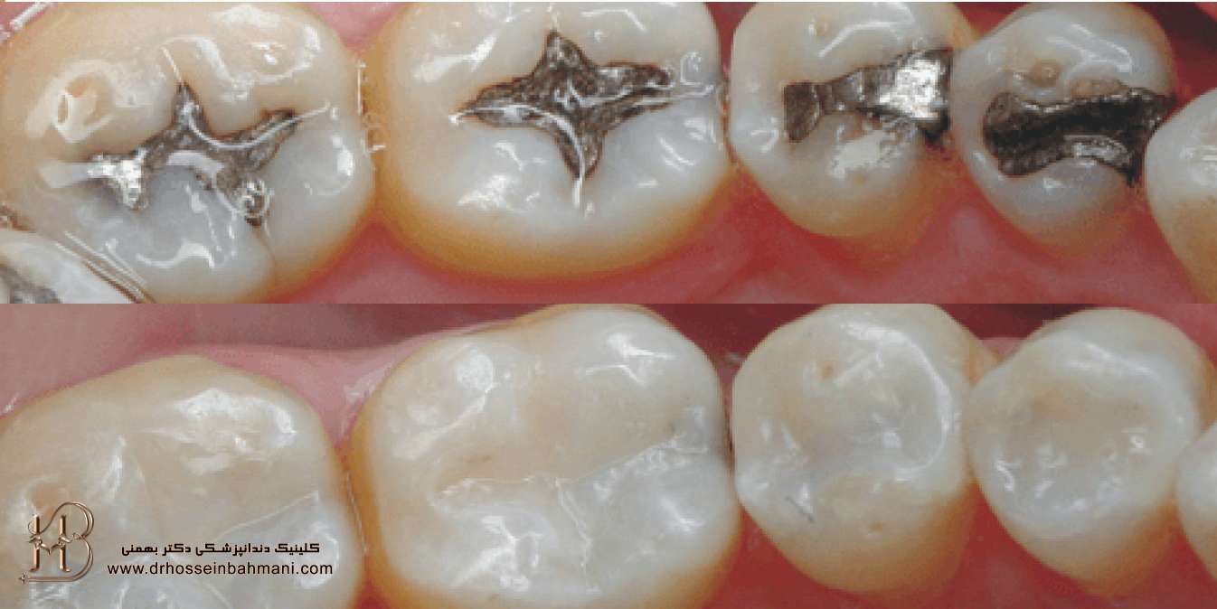 تفاوت آمالگام و ترمیم کامپوزیت دندان