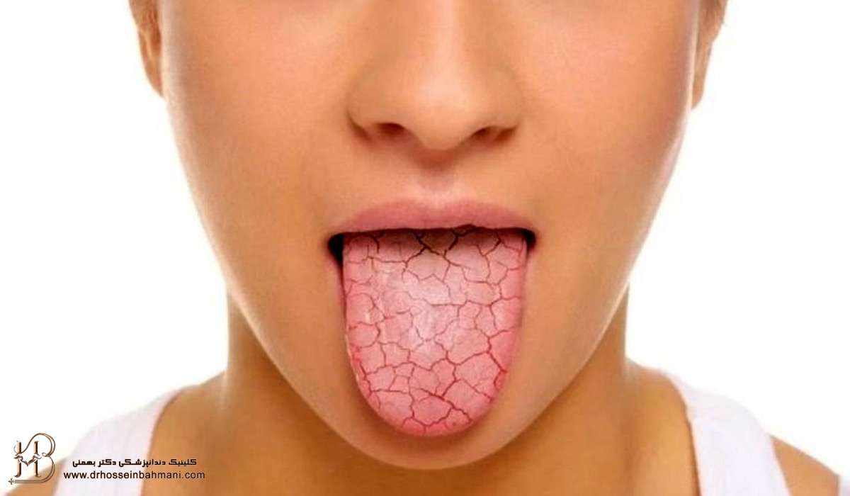 خشکی دهان و زبان