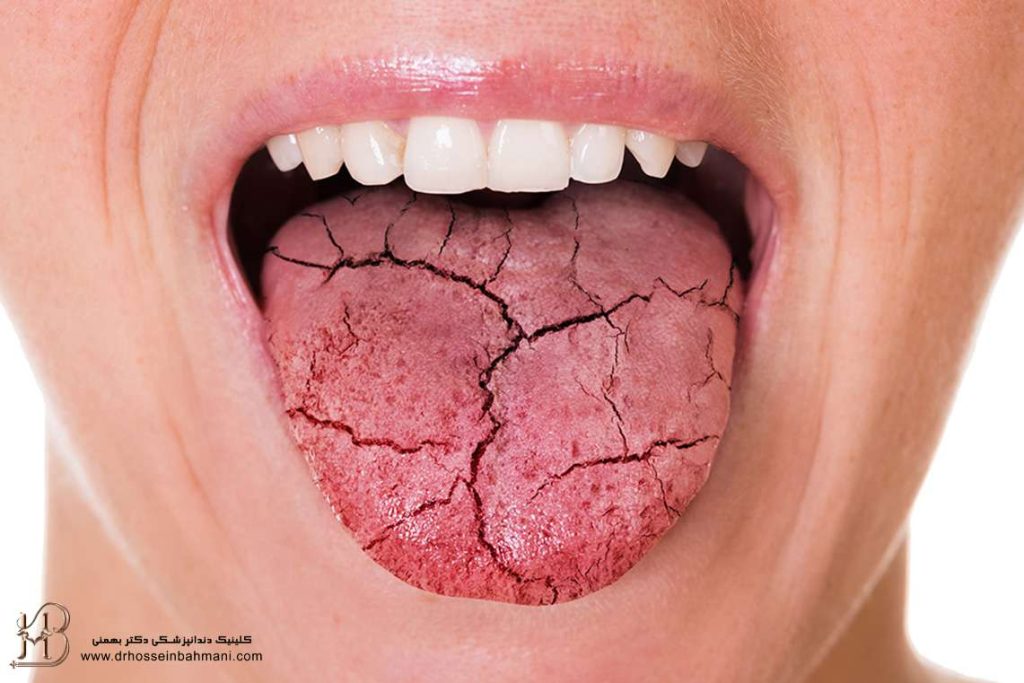 خشکی دهان و زبان از علت تا درمان