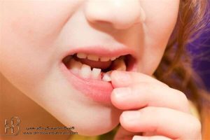 روش های افتادن دندان شیری در خانه بدون درد