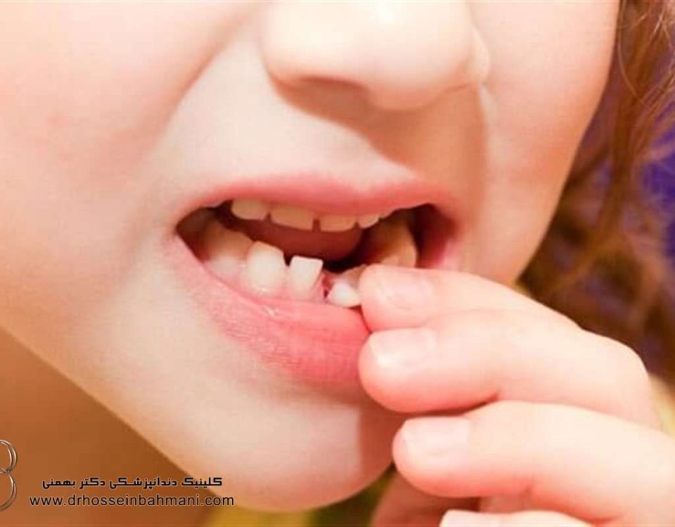 روش های افتادن دندان شیری در خانه بدون درد