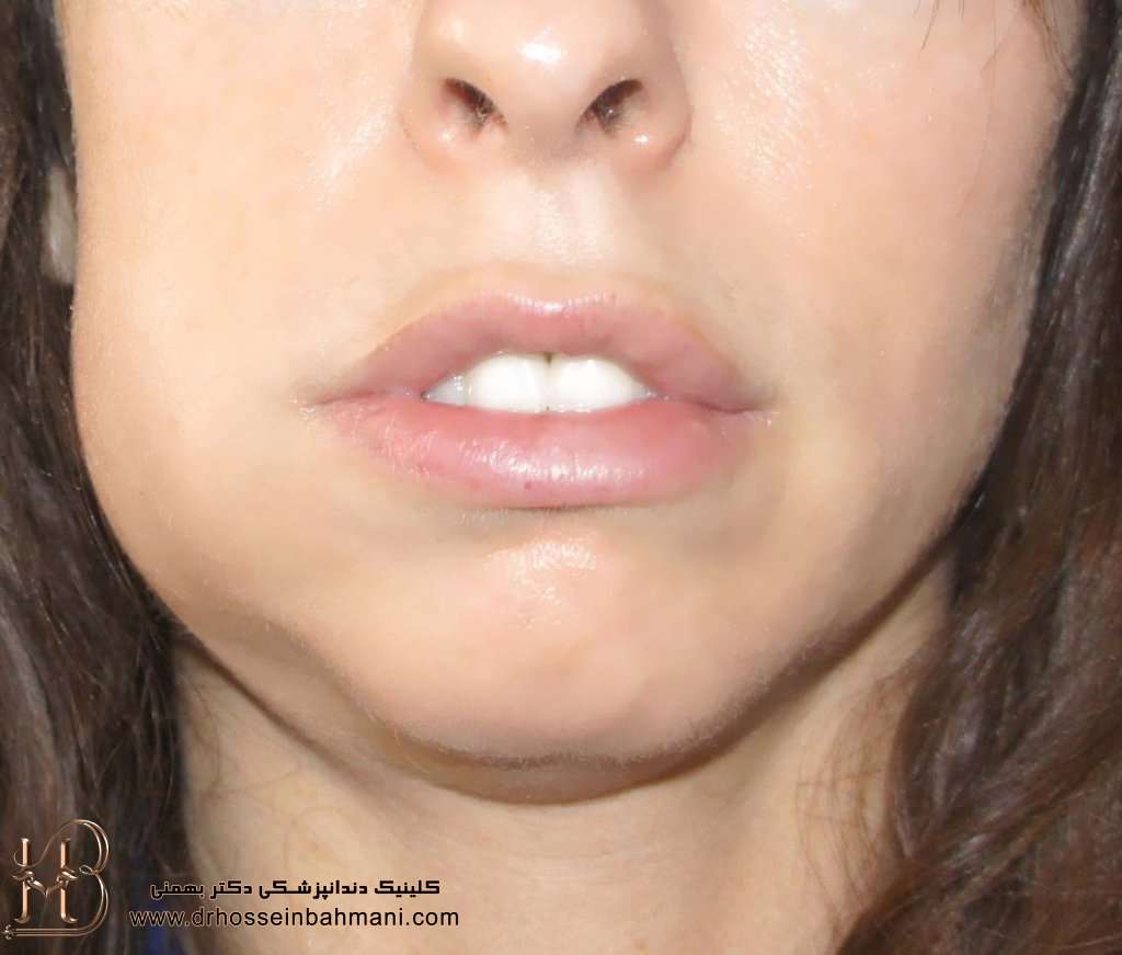 کاهش ورم و التهاب لثه بعد از کشیدن دندان