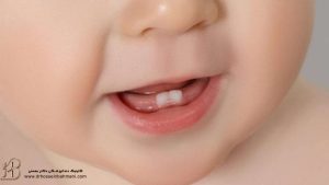 علت دیر دندان درآوردن نوزادان و کودکان و درمان