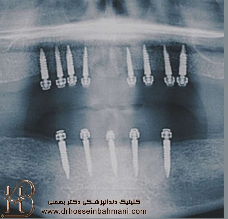 مینی ایمپلنت چیست و چه مزایایی دارد؟