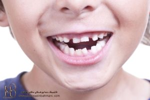 مشکلات احتمالی رویش دندان‌های دائمی در کودکان