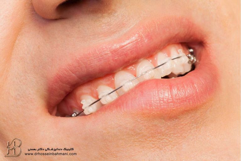 چند روش خانگی برای کاهش درد ارتودنسی ثابت