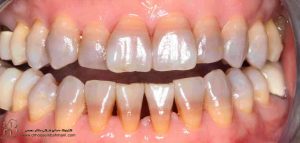 تغییر رنگ شدید دندان را با لمینت درمان کنیم یا کامپوزیت؟