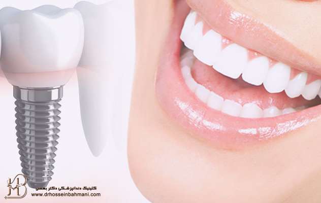 مقایسه ایمپلنت و دندان طبیعی