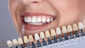 رنگ دندان در روش کامپوزیت چقدر باید سفید باشد؟